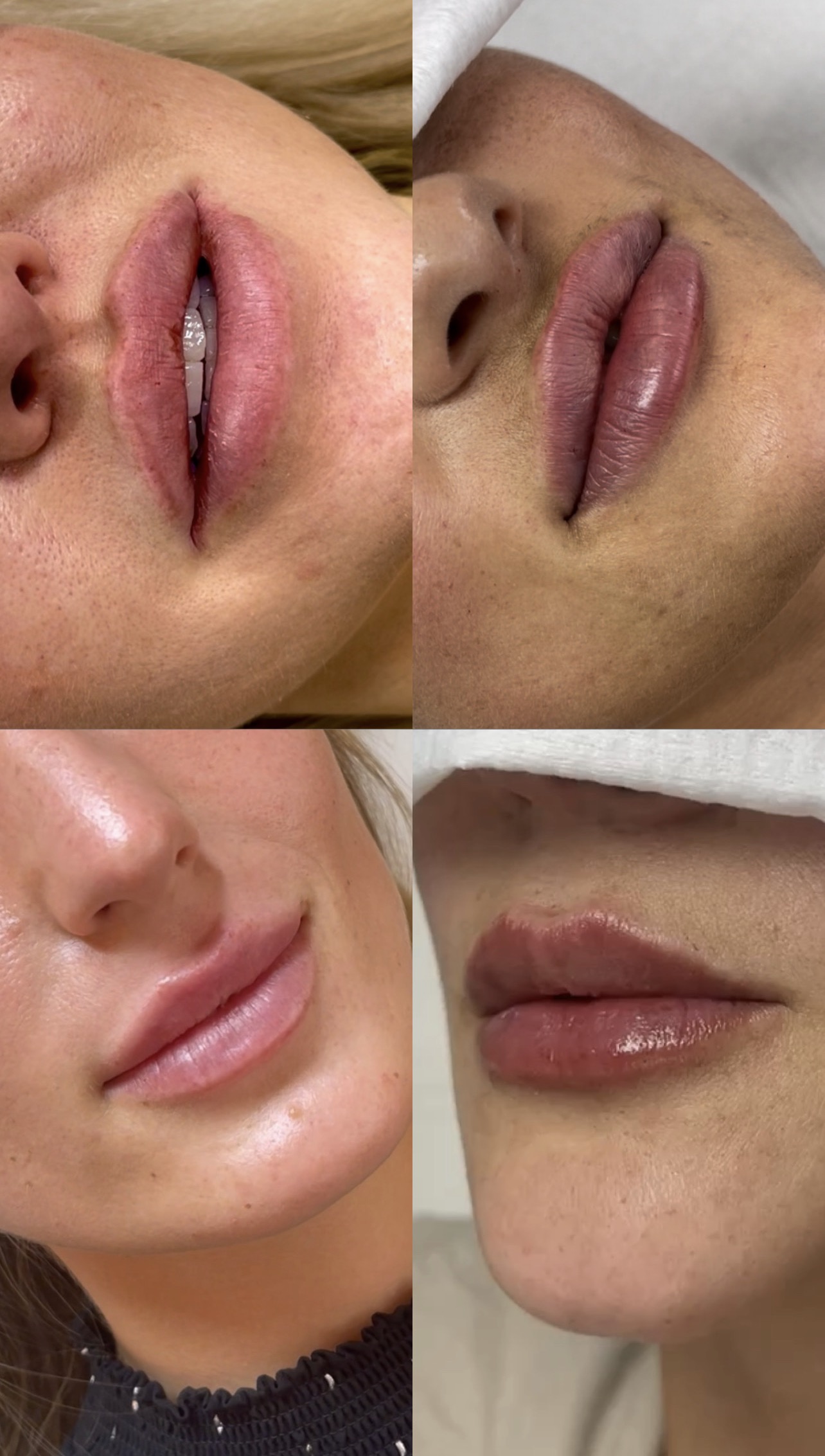Bilder von aufgespritzten Lippen.